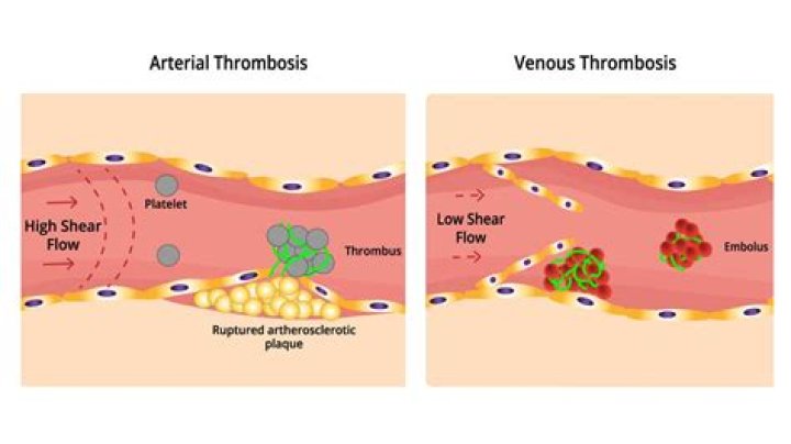 How does inflammation cause thrombosis?