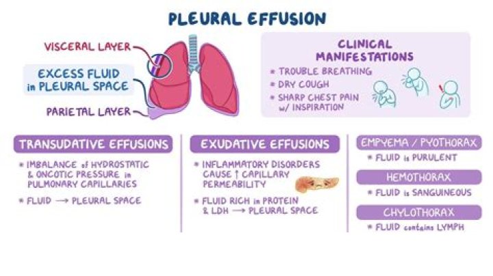 How does TB cause pleural effusion?