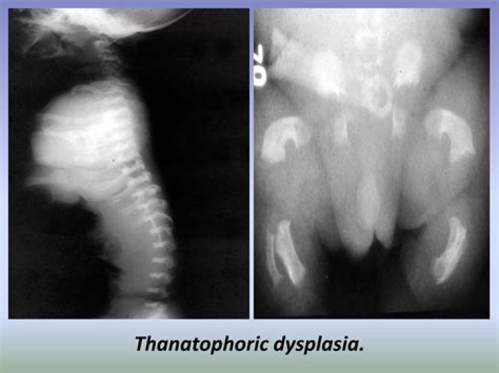 How early can Thanatophoric dysplasia be detected?