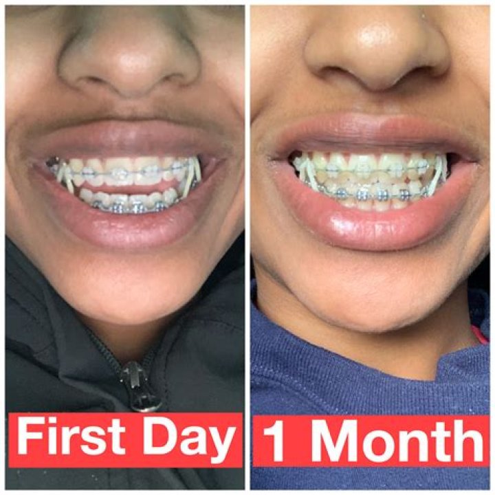 How fast do you see results with braces?