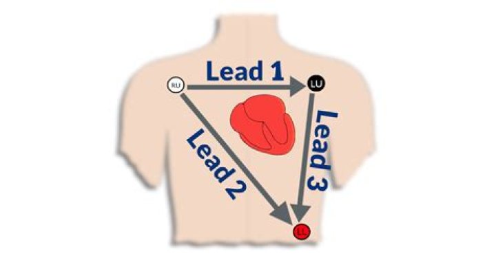 How good is a 1 lead ECG?
