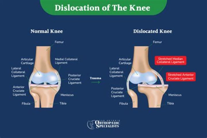 How is a dislocated IOL treated?