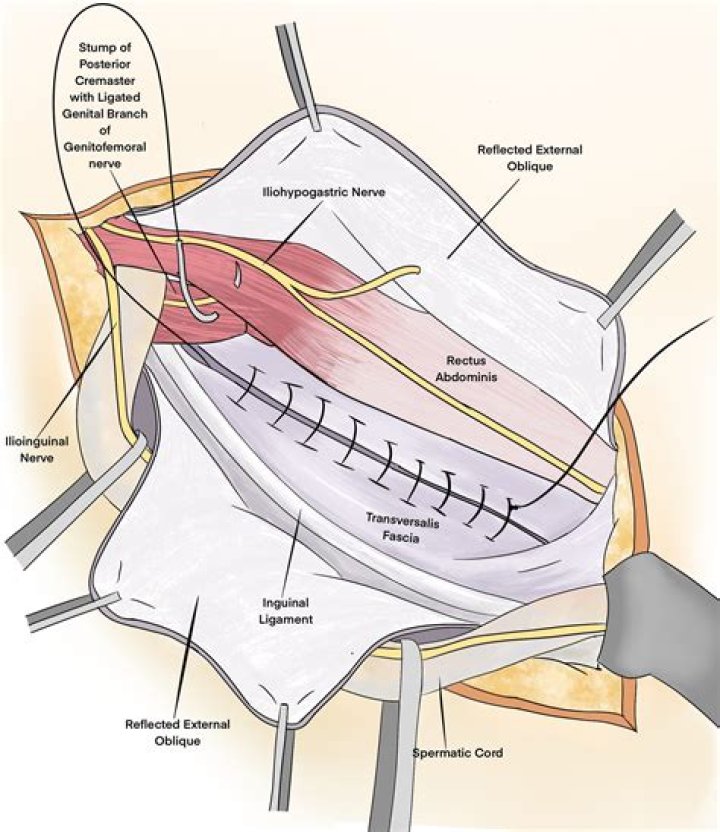 How is a spermatic cyst treated?