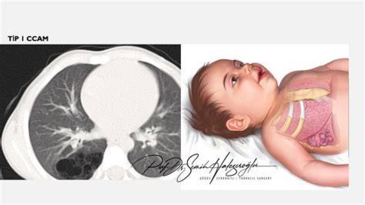 How is congenital lobar emphysema diagnosed?