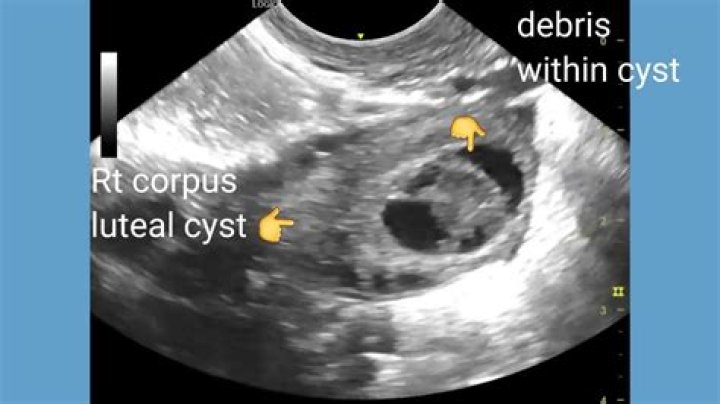 How is corpus luteum cyst diagnosed?
