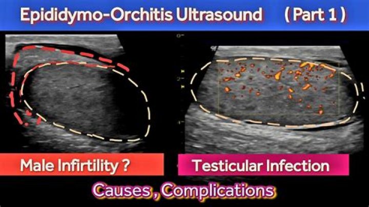 How is Epididymo-orchitis diagnosed?