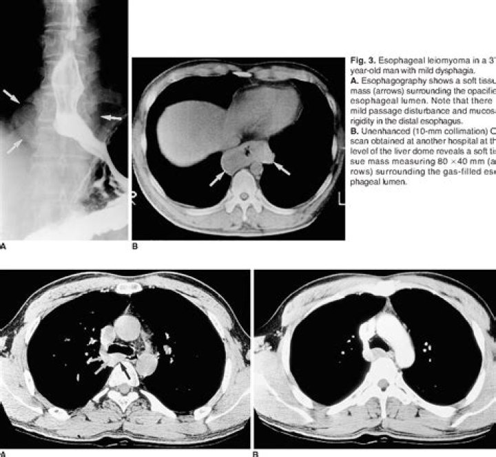 How is esophageal leiomyoma diagnosed?