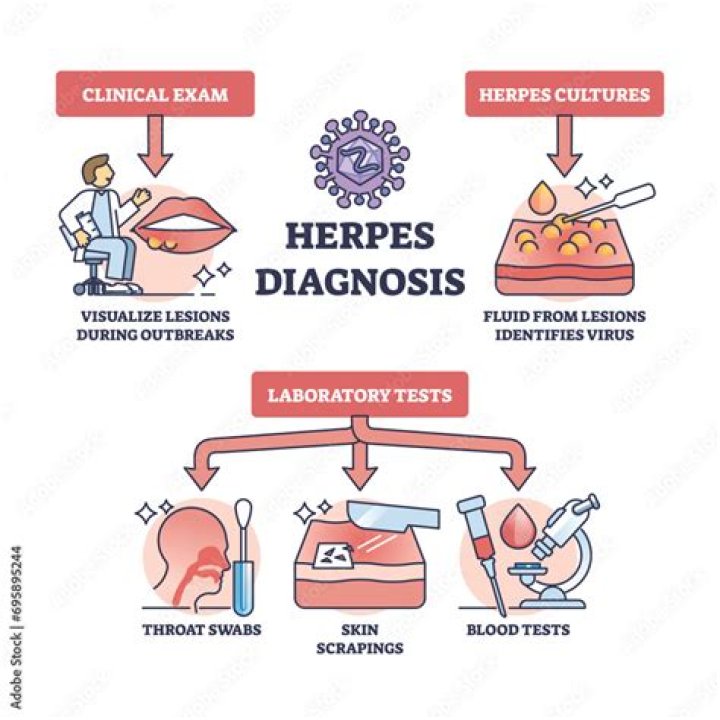 How is herpes keratitis diagnosis?