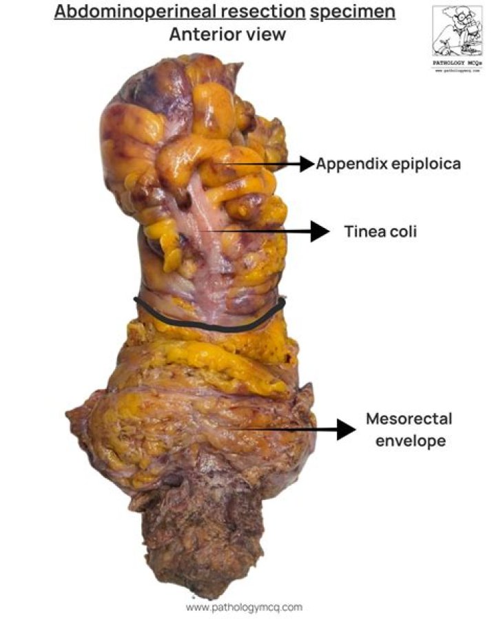 How is lower anterior resection done?