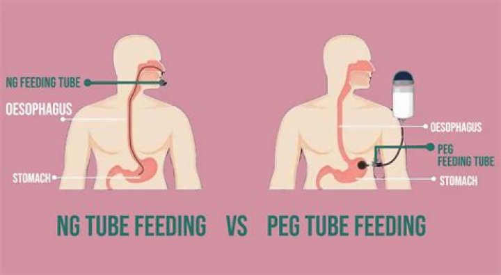 How is NGT feeding calculated?