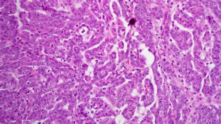 How is serous carcinoma diagnosed?
