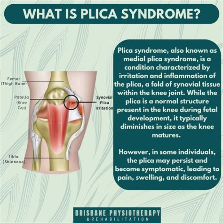 How is synovial plica treated?