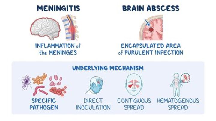 How is TB meningitis diagnosed in CSF?