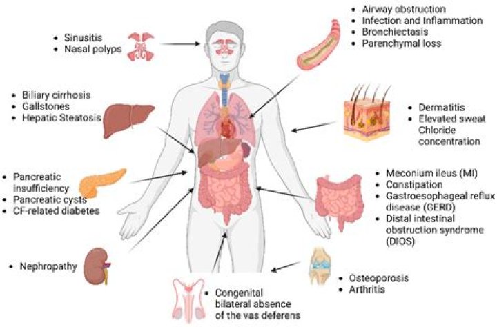 How is the digestive system affected by cystic fibrosis?