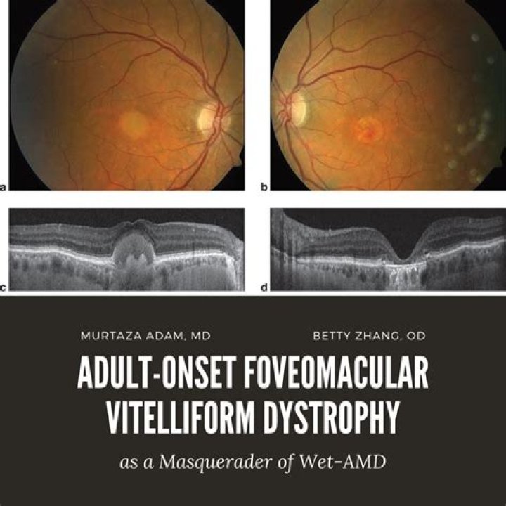 How is Vitelliform macular dystrophy diagnosed?