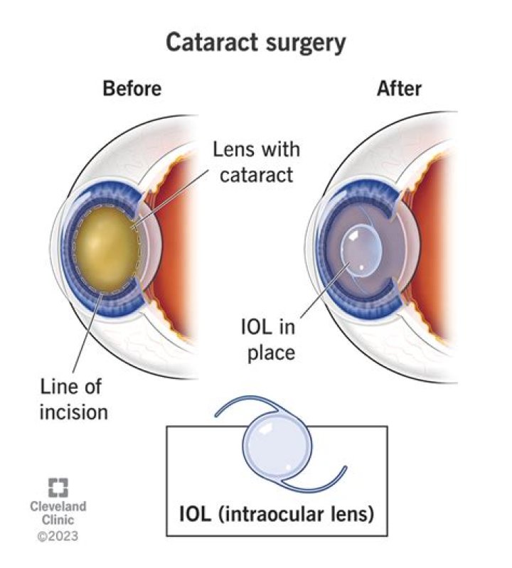 How long after cataract surgery can you rub your eye?