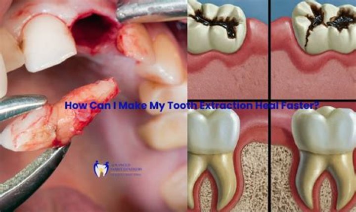 How long after tooth extraction will it feel normal?
