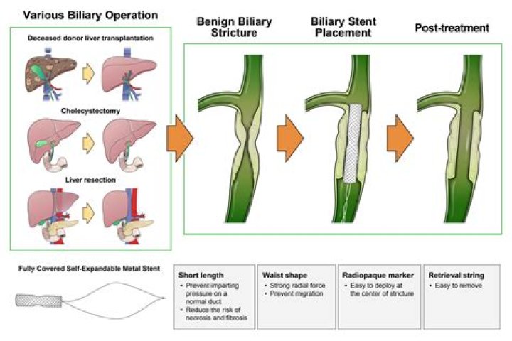 How long can a stent stay in the bile duct?