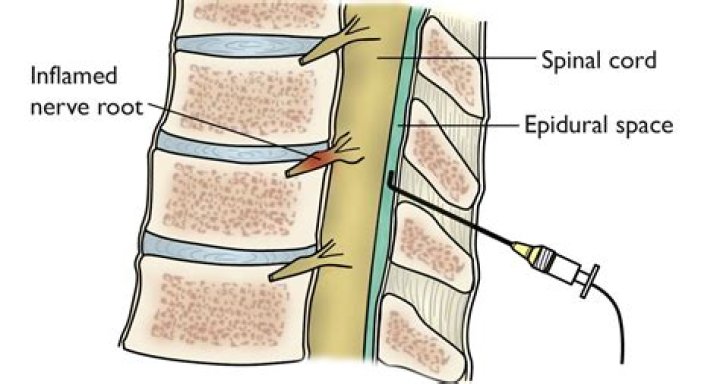 How long do epidural spinal injections last?