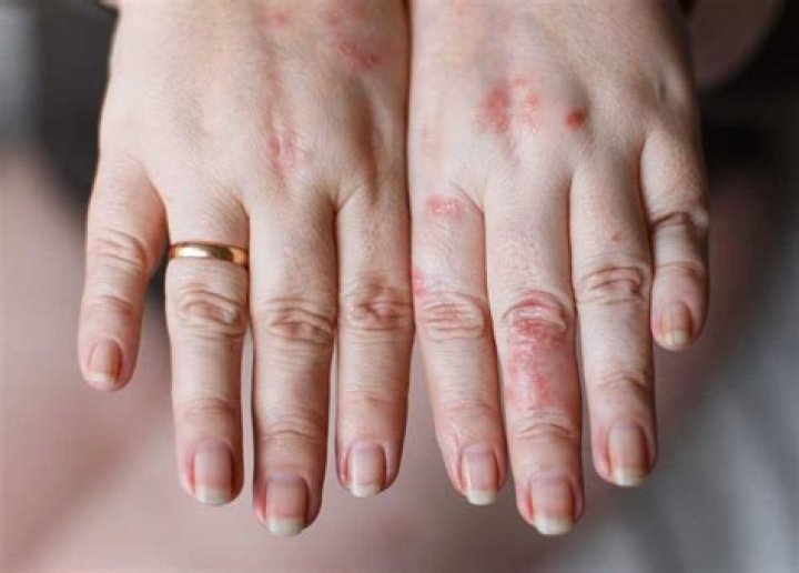 How long do hives last from laundry detergent?