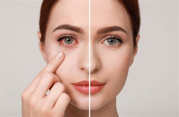 How long do Restor lenses last?