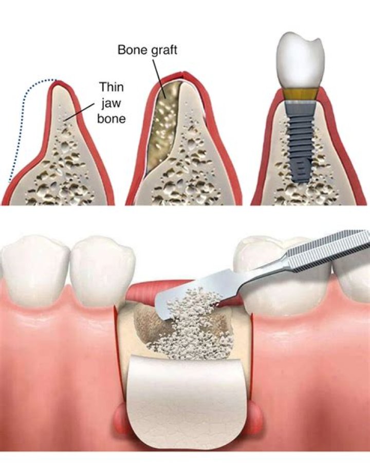 How long do you have pain after a dental bone graft?