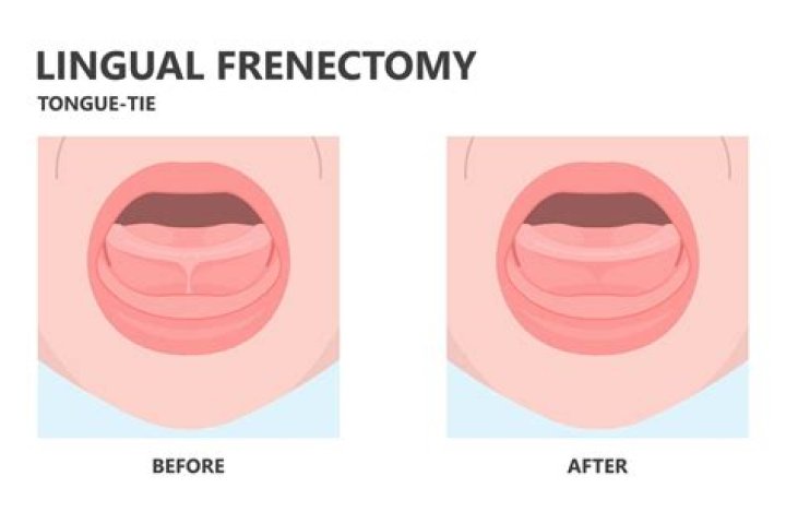 How long does a lingual frenectomy take to heal?