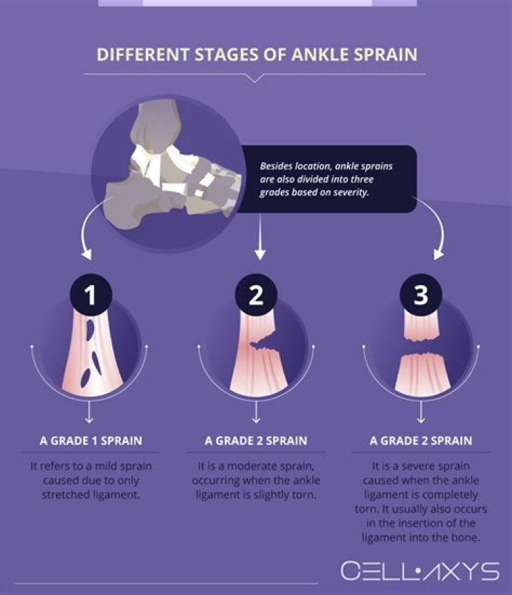 How long does a microfracture take to heal ankle?