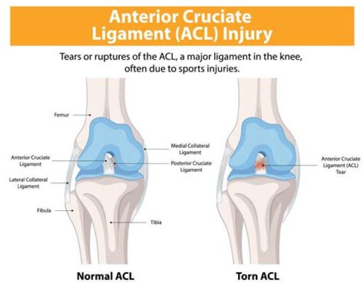 How long does an ACL tear take to heal?