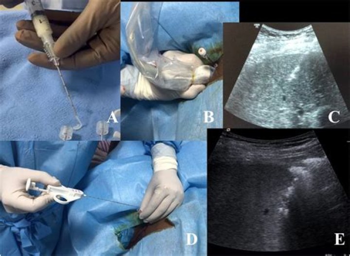 How long does an ultrasound guided liver biopsy take?