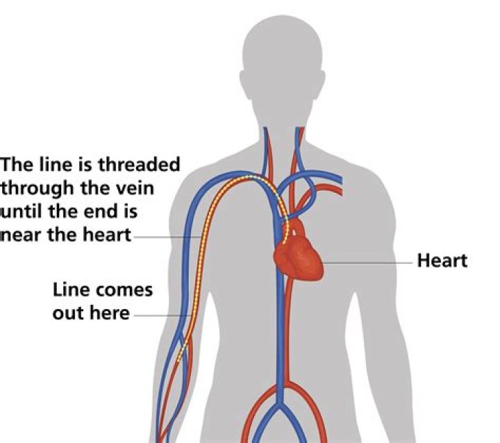 How long does broviac line last?