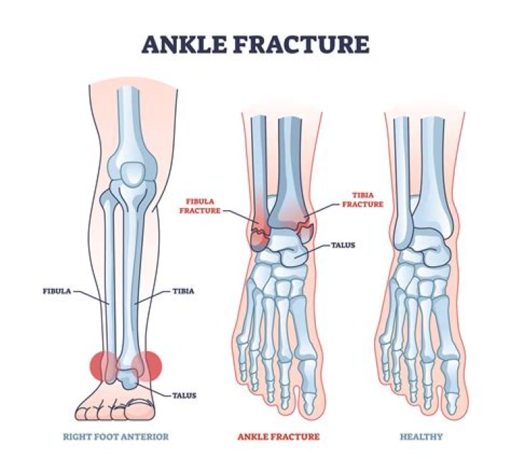 How long does it take for a healed fractured ankle to feel normal?