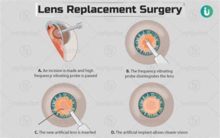 How long does it take for eyes to heal after lens replacement?