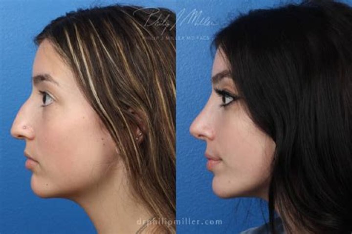 How long does the tip of the nose stay swollen after rhinoplasty?