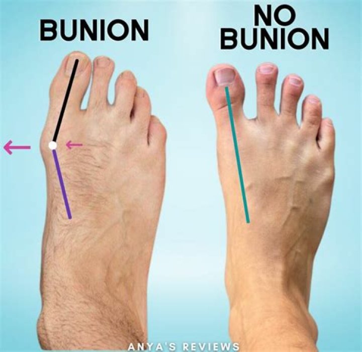 How long is physical therapy after bunion surgery?