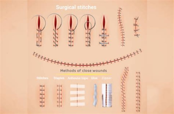 How long should Steri-Strips stay on C-section?