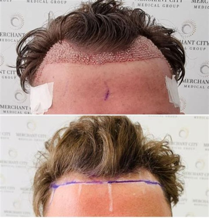 How much does Hair Transplant cost?
