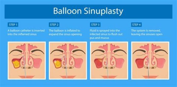 How much does it cost for balloon sinuplasty?