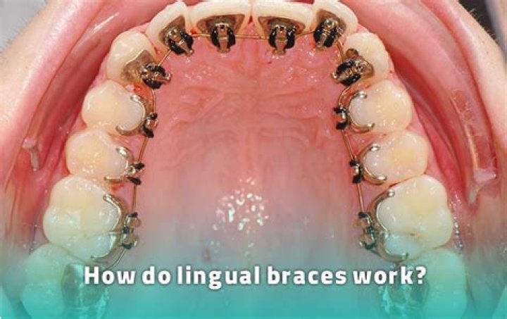 How much more expensive are lingual braces?
