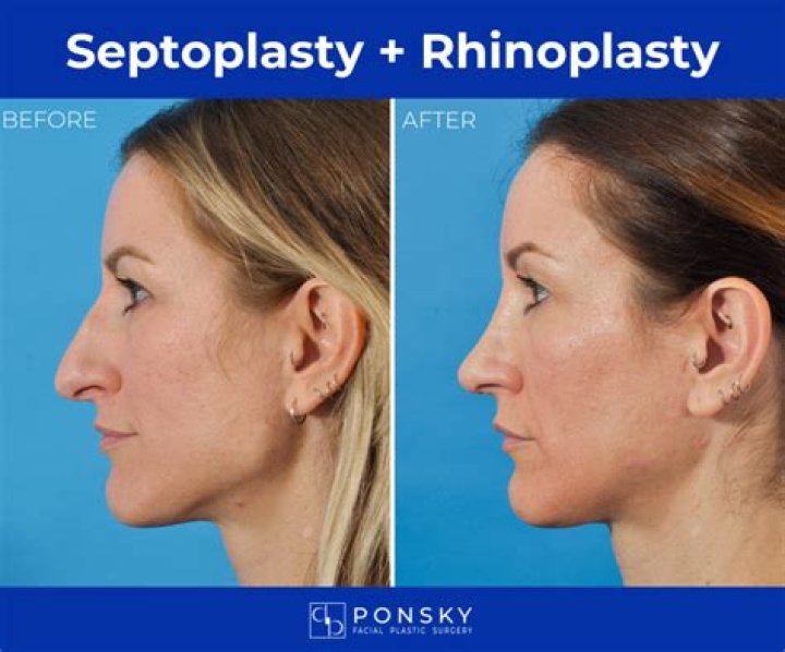 How old do I have to be to get a septoplasty?