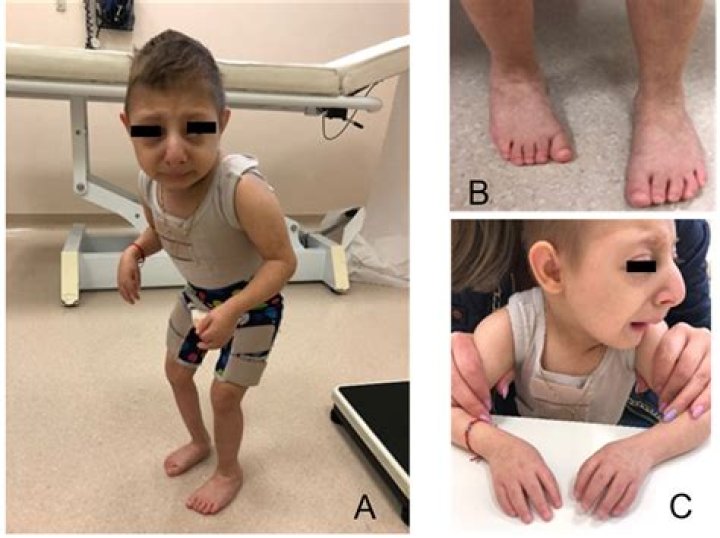 How rare is Seckel syndrome?