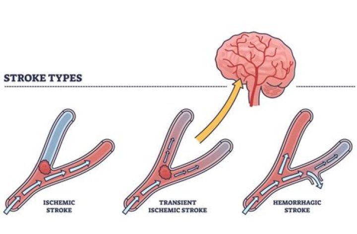 How serious is a TIA stroke?