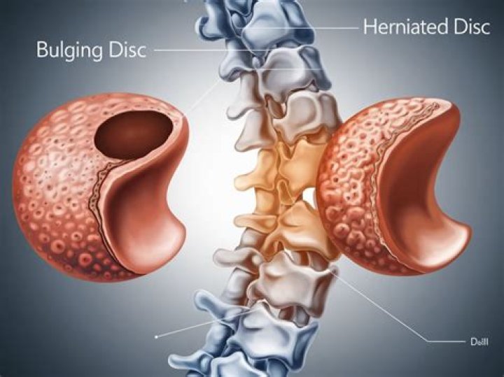 How successful is back surgery for bulging disc?