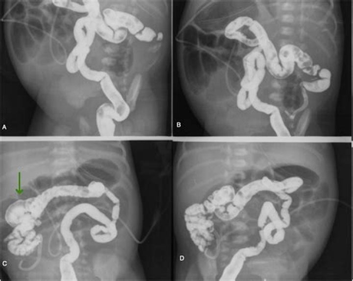 How to diagnose duodenal hematoma?
