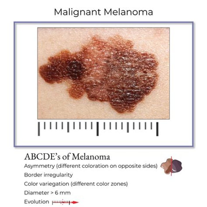 How would a malignant melanoma diagnosis be confirmed?