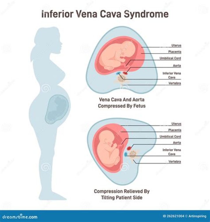 In which position should the pregnant woman lie to best relieve vena cava syndrome?