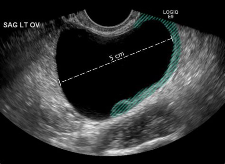 Is 5 cm big for an ovarian cyst?