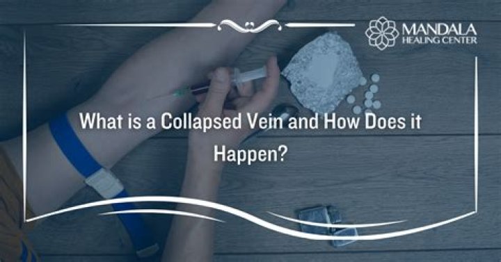 Is a collapsed vein serious?