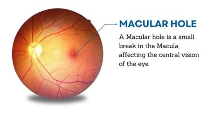 Is a macular hole and retina hole the same?