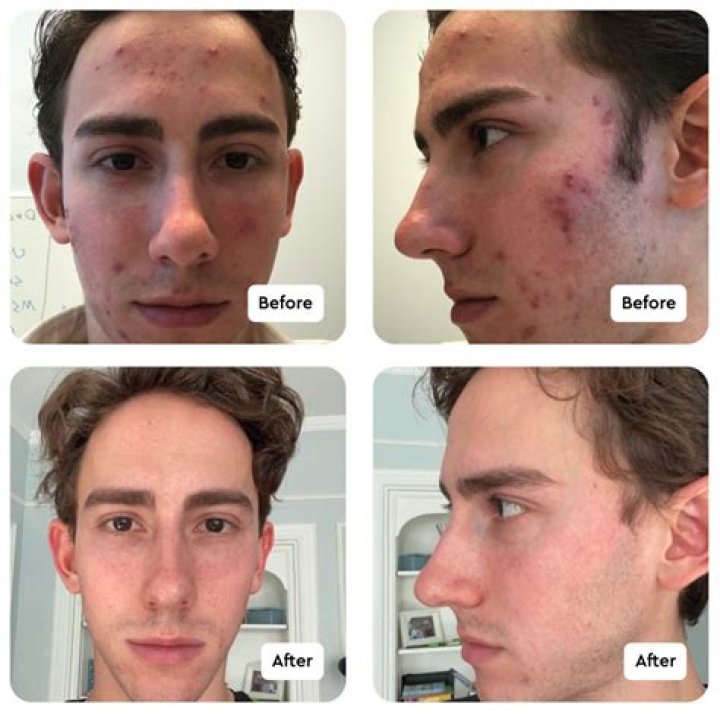 Is Accutane the strongest acne treatment?